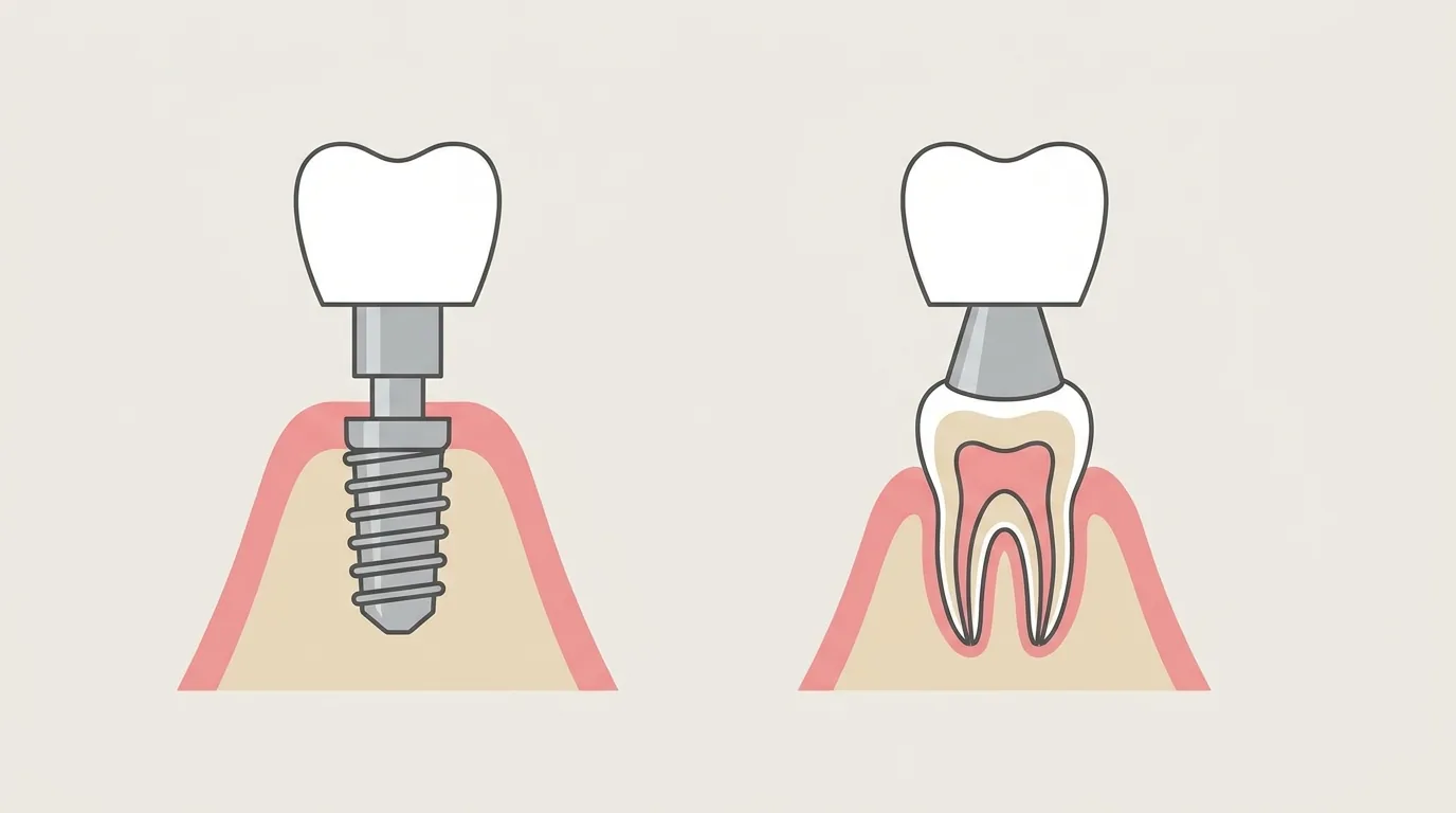 Couronne implanto-portée vs couronne dentoportée Schéma comparant une couronne implanto-portée sur implant en titane et une couronne dentoportée sur dent naturelle
