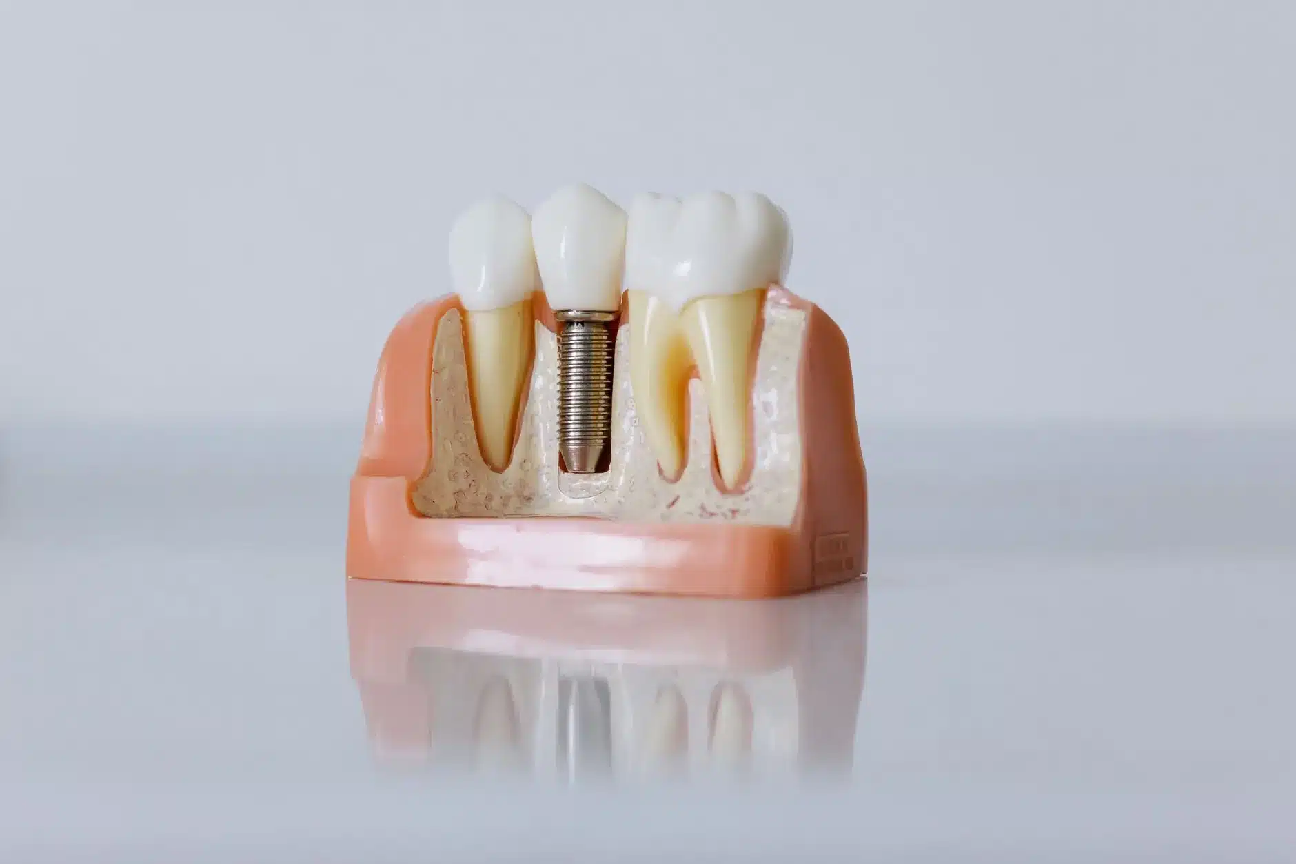 Structure détaillée d'un implant dentaire montrant les composants pour comprendre le prix et le remboursement CMU