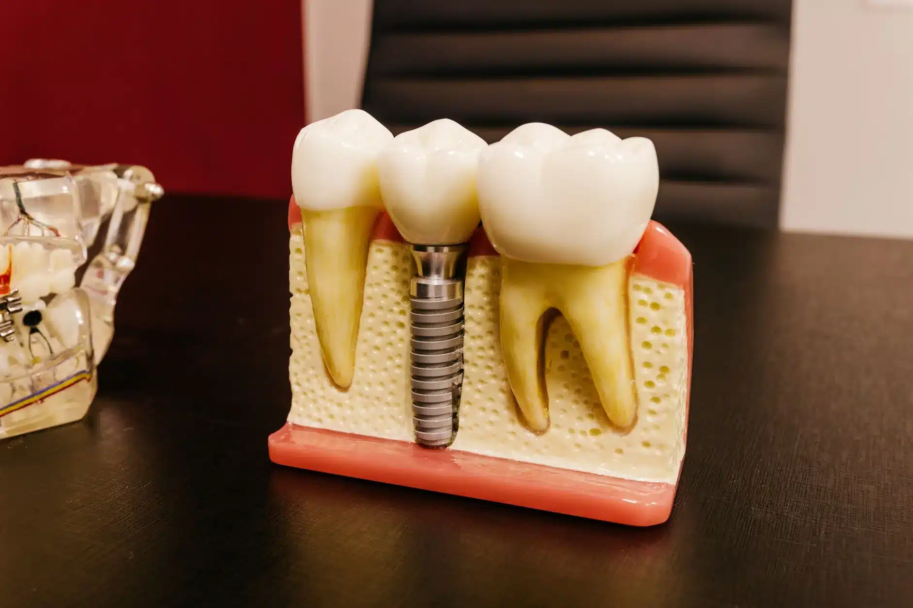 Gros plan d'un modèle d'implant dentaire professionnel montrant le prix remboursé par la CMU